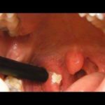 Tonsil Stone via tumblr fuckyeadentistry