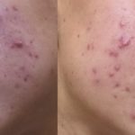 skin12