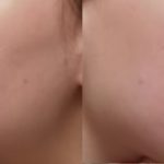 skinlater-1