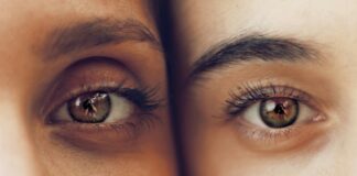 No More Raccoon Eyes: How I Finally Dealt With My Beauty Concerns