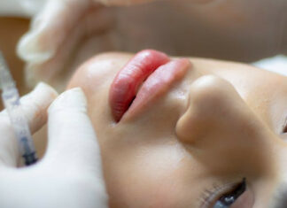 Does 0.5ml Lip Filler For “Russian Lips” Make A Noticeable Difference? Lip Filler