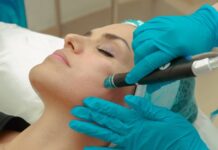 Can RF Microneedling Help Reduce Acne Scars?