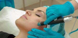 Can RF Microneedling Help Reduce Acne Scars?