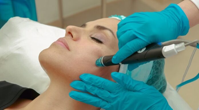 Can RF Microneedling Help Reduce Acne Scars?