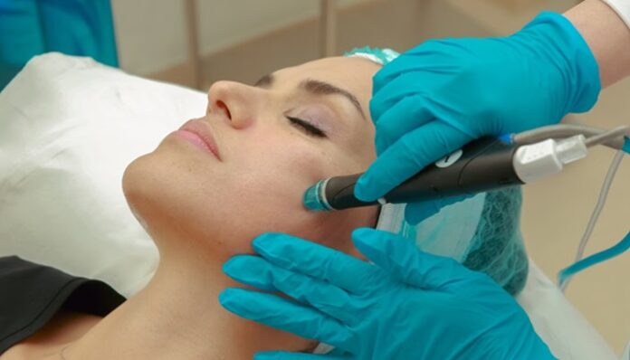 microneedling